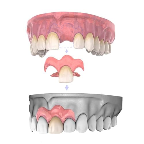 Dentellea 入れ歯 カスタム 義歯 部分いれば 取り外し可能 自然な見た目 2本